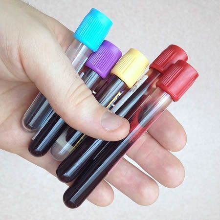 About rarest Blood Type, The Rh Null or Golden Blood only found in 43 people accross the World