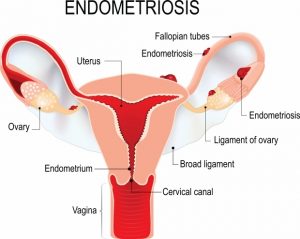The 6 signs you’re suffering endometriosis that plagues 1 in 10 women and takes 10 YEARS to diagnose